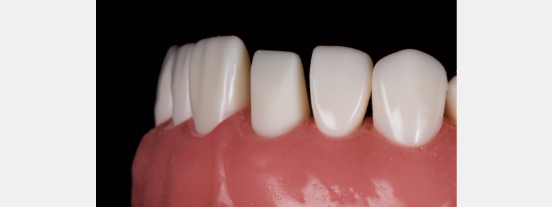 Old Tricks for New Dogs: Vertical Margin in Fixed Prosthodontics JasonSmithson OldTricksNewDogsVertMargin Fig.28
