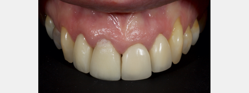 Old Tricks for New Dogs: Vertical Margin in Fixed Prosthodontics JasonSmithson OldTricksNewDogsVertMargin Fig.29