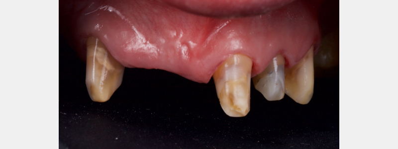 Old Tricks for New Dogs: Vertical Margin in Fixed Prosthodontics JasonSmithson OldTricksNewDogsVertMargin Fig.3