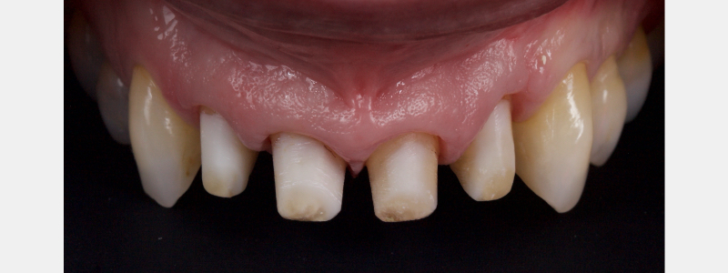 Old Tricks for New Dogs: Vertical Margin in Fixed Prosthodontics JasonSmithson OldTricksNewDogsVertMargin Fig.30