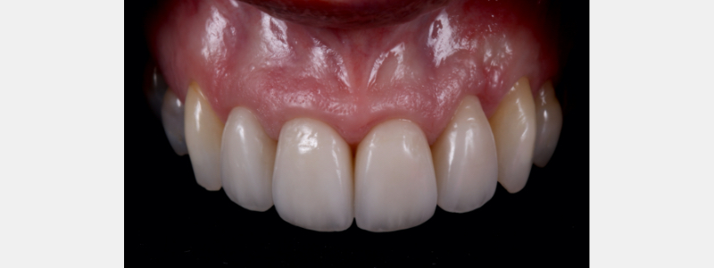 Old Tricks for New Dogs: Vertical Margin in Fixed Prosthodontics JasonSmithson OldTricksNewDogsVertMargin Fig.31