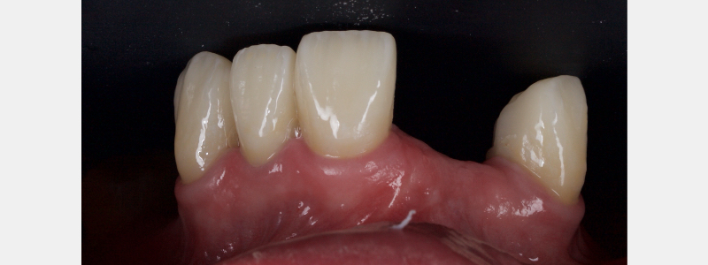 Old Tricks for New Dogs: Vertical Margin in Fixed Prosthodontics JasonSmithson OldTricksNewDogsVertMargin Fig.4