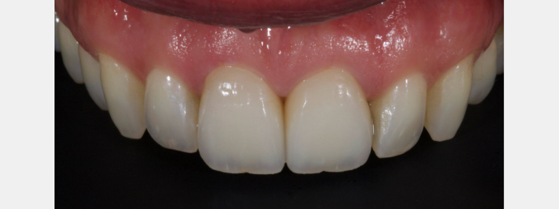 Old Tricks for New Dogs: Vertical Margin in Fixed Prosthodontics JasonSmithson OldTricksNewDogsVertMargin Fig.6