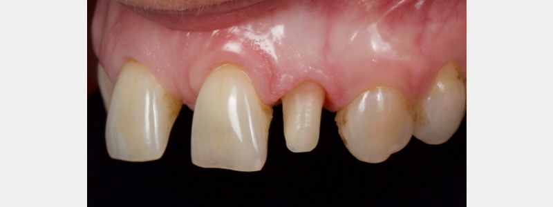 Old Tricks for New Dogs: Vertical Margin in Fixed Prosthodontics JasonSmithson OldTricksNewDogsVertMargin Fig.7