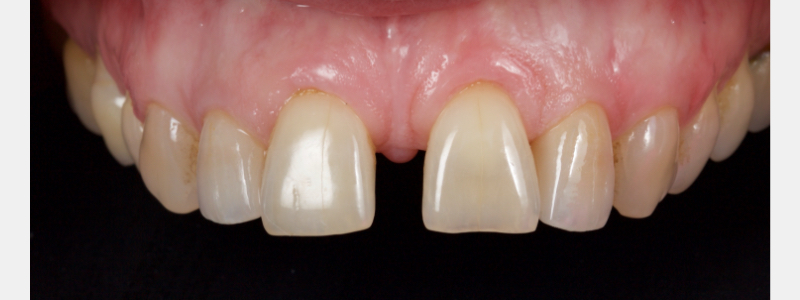Old Tricks for New Dogs: Vertical Margin in Fixed Prosthodontics JasonSmithson OldTricksNewDogsVertMargin Fig.8