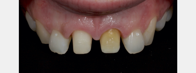 Old Tricks for New Dogs: Vertical Margin in Fixed Prosthodontics JasonSmithson OldTricksNewDogsVertMargin Fig.9