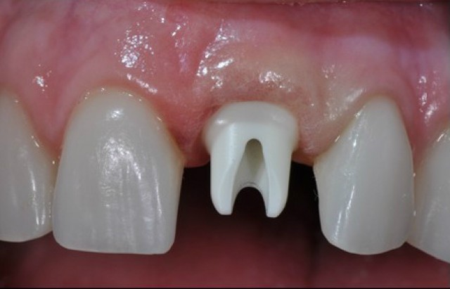 Single Anterior Implants Made Easy As 1-2-3 Jeffrey Bonk Single Anterior Implants Made Easy Featured Image