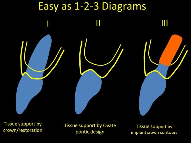Single Anterior Implants Made Easy As 1-2-3 Jeffrey Bonk Single Anterior Implants Made Easy Figure 1