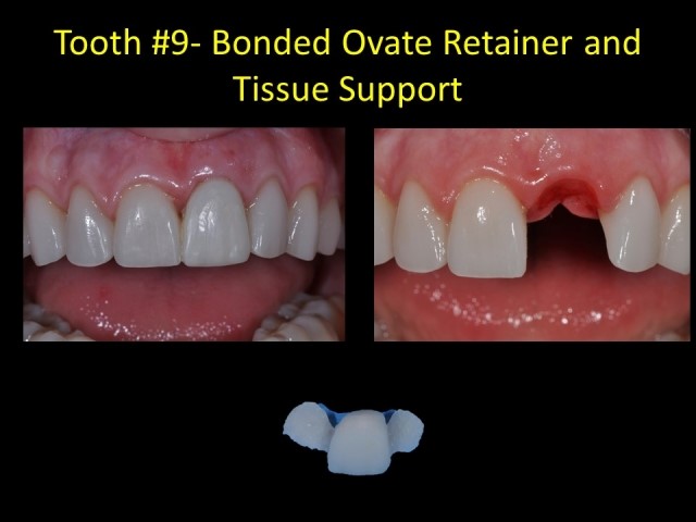 Single Anterior Implants Made Easy As 1-2-3 Jeffrey Bonk Single Anterior Implants Made Easy Figure 3