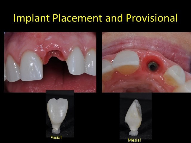 Single Anterior Implants Made Easy As 1-2-3 Jeffrey Bonk Single Anterior Implants Made Easy Figure 4