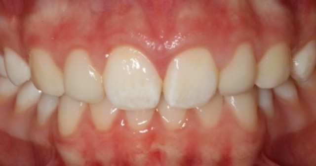 Spear Digest JeffreyBonk GoldenPercentDentIdealTooth FeaturedImage