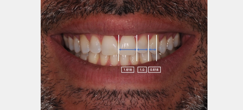 Using Golden Percentage in Dentistry for Ideal Tooth Proportions JeffreyBonk GoldenPercentDentIdealTooth Fig.3