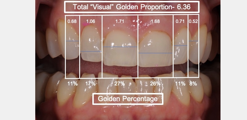 Using Golden Percentage in Dentistry for Ideal Tooth Proportions JeffreyBonk GoldenPercentDentIdealTooth Fig.4