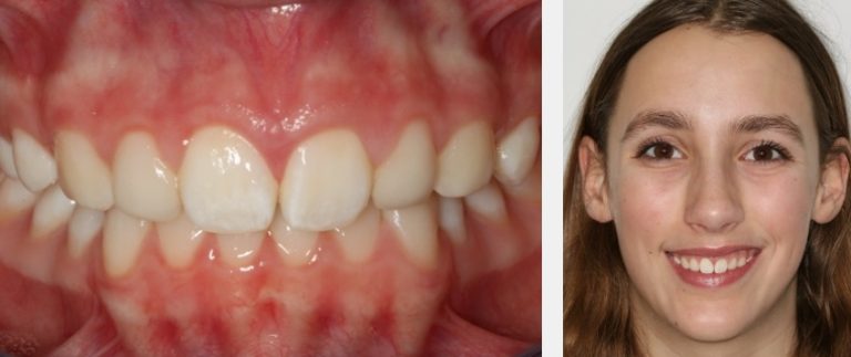 Using Golden Percentage in Dentistry for Ideal Tooth Proportions ...