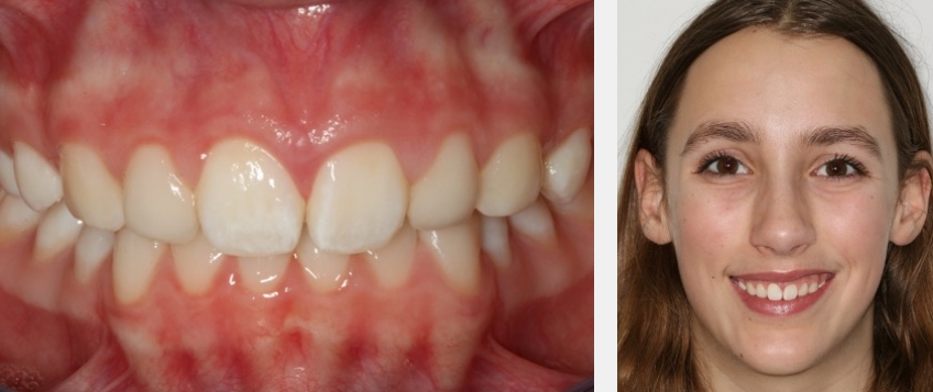 Using Golden Percentage in Dentistry for Ideal Tooth Proportions JeffreyBonk GoldenPercentDentIdealTooth Fig.9