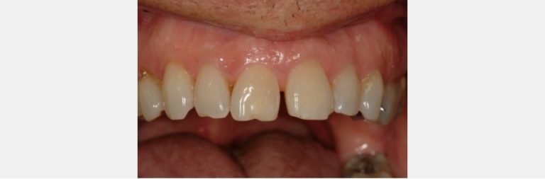 Managing Diastemas With Veneers