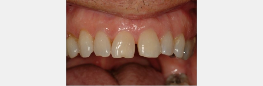 Managing Diastemas With Veneers JeffreyBonk ManagingDiastemasVeneers Fig.1