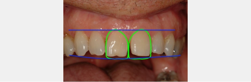 Managing Diastemas With Veneers JeffreyBonk ManagingDiastemasVeneers Fig.2
