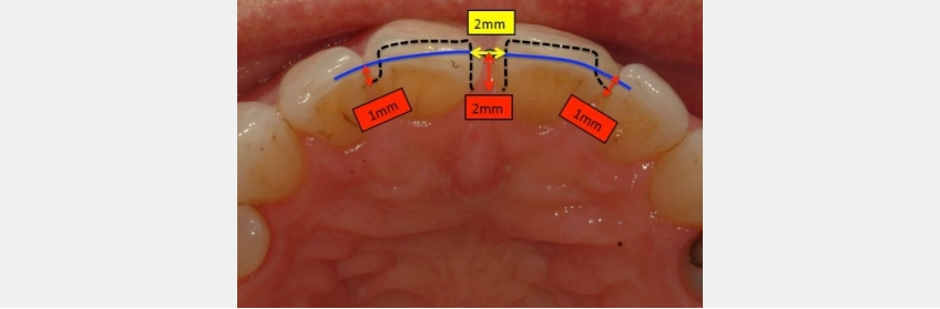 Managing Diastemas With Veneers JeffreyBonk ManagingDiastemasVeneers Fig.3