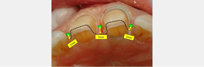 Managing Diastemas With Veneers JeffreyBonk ManagingDiastemasVeneers Fig.4