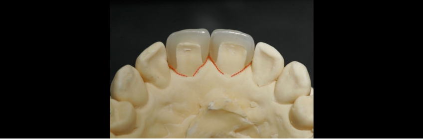 Managing Diastemas With Veneers JeffreyBonk ManagingDiastemasVeneers Fig.5