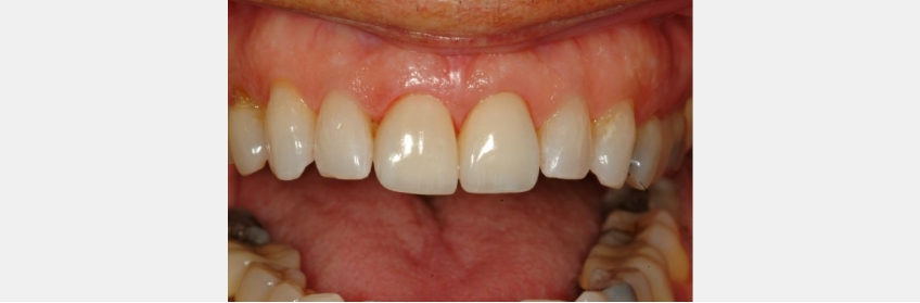 Managing Diastemas With Veneers JeffreyBonk ManagingDiastemasVeneers Fig.6