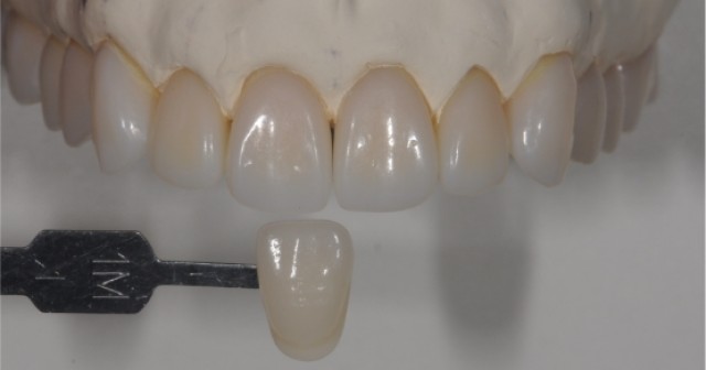 A Quick Tooth Shade Matching Technique to Simplify the Chairside Process