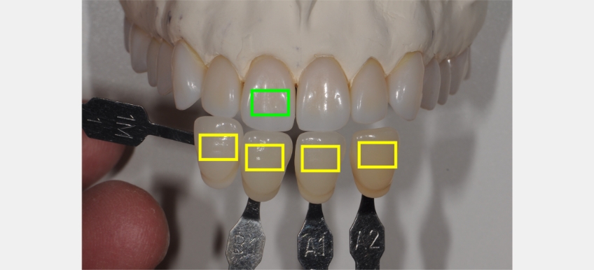 A Quick Tooth Shade Matching Technique to Simplify the Chairside Process JeffreyBonk QuickToothShadeMatchTech Fig.2