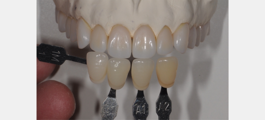 A Quick Tooth Shade Matching Technique to Simplify the Chairside Process JeffreyBonk QuickToothShadeMatchTech Fig.3