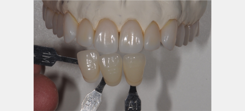 A Quick Tooth Shade Matching Technique to Simplify the Chairside Process JeffreyBonk QuickToothShadeMatchTech Fig.4