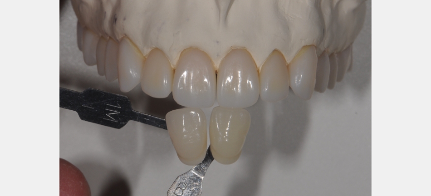 A Quick Tooth Shade Matching Technique to Simplify the Chairside Process JeffreyBonk QuickToothShadeMatchTech Fig.5
