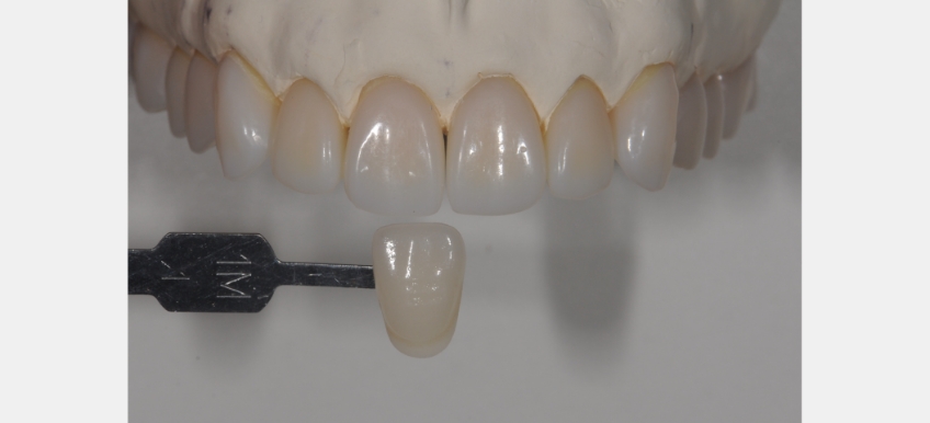 A Quick Tooth Shade Matching Technique to Simplify the Chairside Process JeffreyBonk QuickToothShadeMatchTech Fig.6