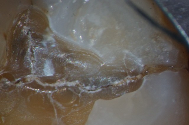 4 Questions To Ask When Evaluating Cracked Teeth John Carson 4 Questions to Ask When Evaluating Cracked Teeth Featured Image