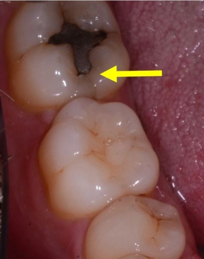 4 Questions To Ask When Evaluating Cracked Teeth John Carson 4 Questions to Ask When Evaluating Cracked Teeth Figure 3