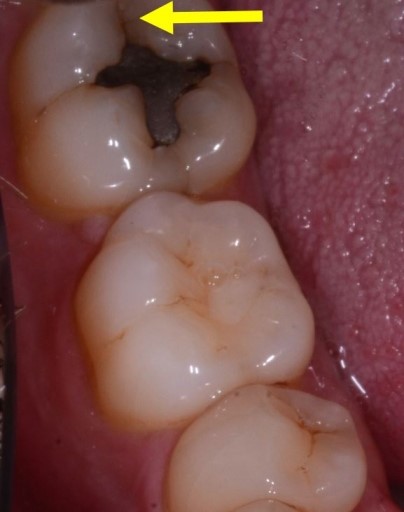 4 Questions To Ask When Evaluating Cracked Teeth John Carson 4 Questions to Ask When Evaluating Cracked Teeth Figure 4