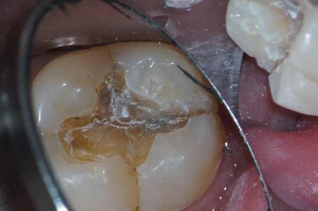 4 Questions To Ask When Evaluating Cracked Teeth John Carson 4 Questions to Ask When Evaluating Cracked Teeth Figure 5