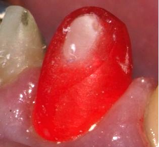 Can a Reduction Coping Help? John Carson Can a Reduction Coping Help Featured Image