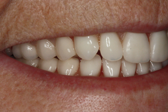 Guidelines for Posterior Denture Teeth Kevin Huff Guidelines for Posterior Denture Teeth Featured Image