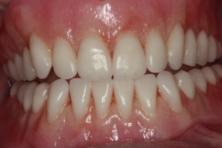 Guidelines for Posterior Denture Teeth Kevin Huff Guidelines for Posterior Denture Teeth Figure 2