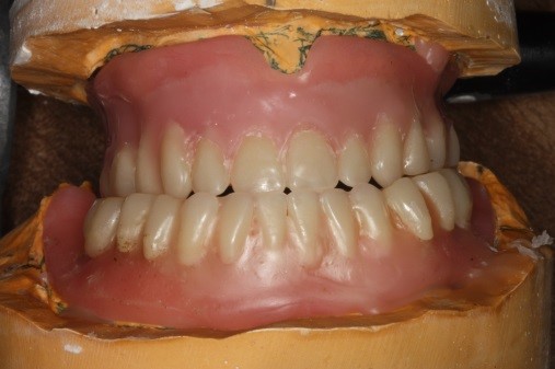 Guidelines for Posterior Denture Teeth Kevin Huff Guidelines for Posterior Denture Teeth Figure 3