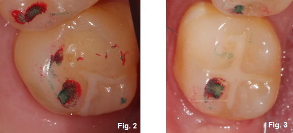 Using a Leaf Gauge With Intention: Part II Kevin Kwiecien Using a Leaf Gauge with Intention Figure 1Kevin Kwiecien Using a Leaf Gauge with Intention Figure 2