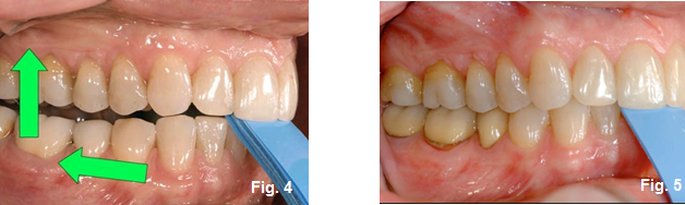 Using a Leaf Gauge With Intention: Part II Kevin Kwiecien Using a Leaf Gauge with Intention Figure 5