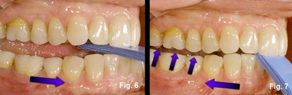 Using a Leaf Gauge With Intention: Part II Kevin Kwiecien Using a Leaf Gauge with Intention Figure 6
