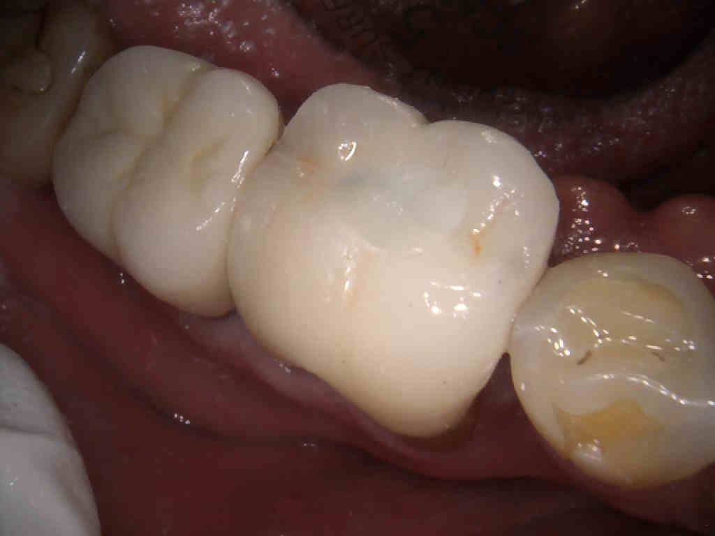 Closing Endo Access Openings Mary Anne Salcetti Closing Endo Access Opening Figure 1