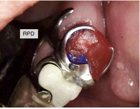 Mary Anne Salcetti Fabricating a Crown to an Existing Removable Partial Denture Figure 1
