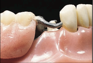 Mary Anne Salcetti Fabricating a Crown to an Existing Removable Partial Denture Figure 2