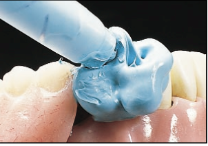 Mary Anne Salcetti Fabricating a Crown to an Existing Removable Partial Denture Figure 3