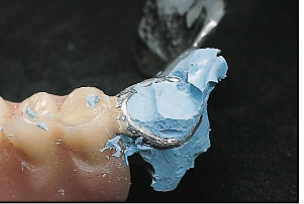 Mary Anne Salcetti Fabricating a Crown to an Existing Removable Partial Denture Figure 4