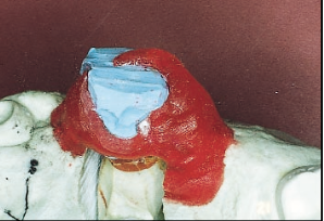 Mary Anne Salcetti Fabricating a Crown to an Existing Removable Partial Denture Figure 5