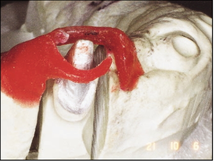 Mary Anne Salcetti Fabricating a Crown to an Existing Removable Partial Denture Figure 6